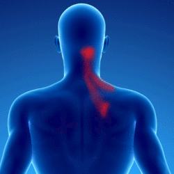 douleur chronique par syndrome myofascial des muscles multifides du cou