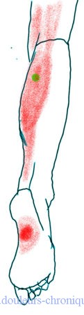 Syndrome myofascial des muscles postérieurs de la jambe