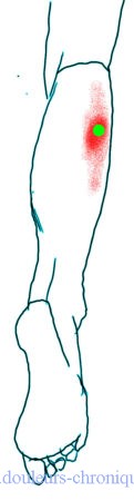 douleurs chroniques : Syndrome myofascial des muscles postérieurs de la jambe