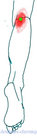 Syndrome myofascial des muscles postérieurs de la jambe