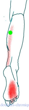 douleurs chroniques : Syndrome myofascial des muscles postérieurs de la jambe