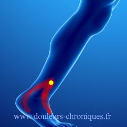 douleurs chroniques par syndrome myofascial des muscles fibulaires
