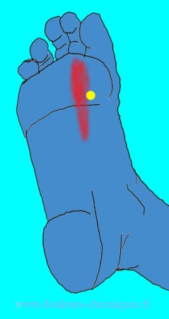 Doulers chroniques par syndrome myofascial des muscles intrinsèques profonds du pied