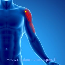 douleur chronique par syndrome myofascial du deltoïde partie antérieure