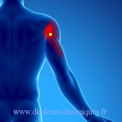 douleur chronique par syndrome myofascial du deltoïde partie postérieure