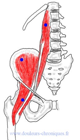 Syndrome myofascial du muscle ilio-psoas. Trigger point