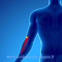 Douleur chronique par syndrome myofascial du muscle triceps brachial
