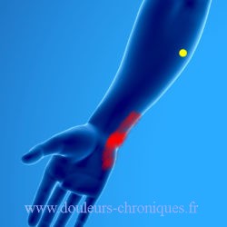 Syndrome myofascial des muscles fléchisseurs de la main et des doigts