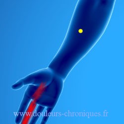 douleur chronique par syndrome myofascial des muscles fléchisseurs de la main et des doigts