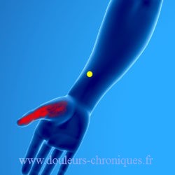 Syndrome myofascial des muscles fléchisseurs de la main et des doigts