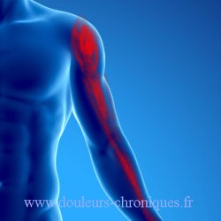 douleur chronique par syndrome myofascial du muscle infra-épineux