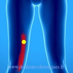 douleur chronique par syndrome myofascial du muscle sartorius