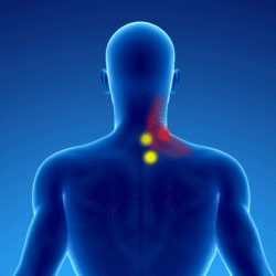 Chronic pain due to myofascial syndrome of the splenius muscle of the neck