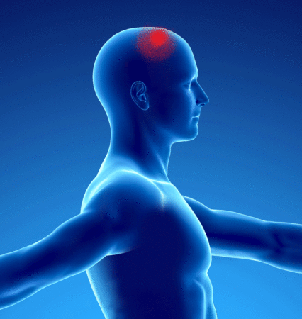dolor de cabeza relacionado con el síndrome miofascial del músculo esplenio del cuello
