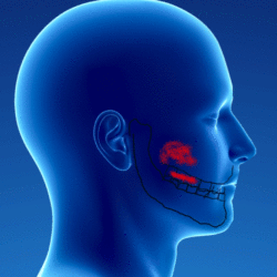 Myofascial syndrome of the masseter muscle