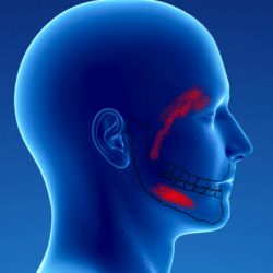 Myofascial syndrome of the masseter muscle