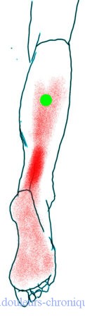 Myofascial syndrome of the posterior leg muscles