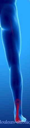 Síndrome miofascial de los músculos posteriores de la pierna