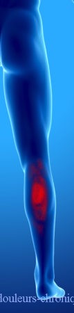 Chronic pain due to myofascial syndrome of the posterior leg muscles