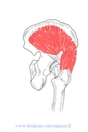 Syndrome myofascial du muscle moyen fessier : muscle du lumbago