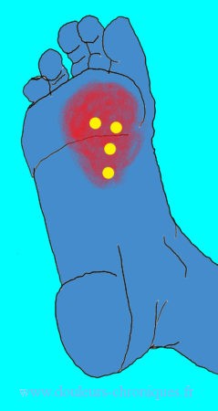 Chronic pain due to myofascial syndrome of the deep intrinsic muscles of the foot