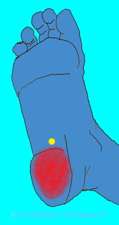 Douleurs chroniques par yndrome myofascial des muscles intrinsèques profonds du pied