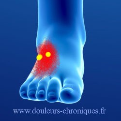 douleurs chroniques par syndrome myofascial du court extenseur des orteils