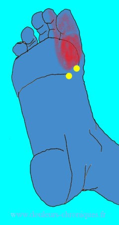 Douleurs chroniques par syndrome myofascial des muscles intrinsèques profonds du pied