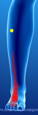 Douleurs chroniques par syndrome myofascial des muscles longs extenseurs des orteils