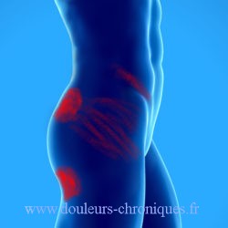 Chronic pain due to myofascial syndrome of the square muscle of the loins