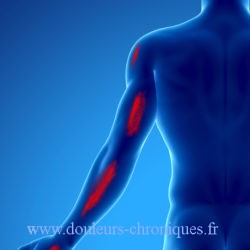 Chronic pain by myofascial syndrome of the coraco-brachialis muscle posterior view