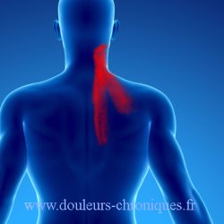 Chronic pain due to myofascial syndrome of the levator scapula muscle. Torticollis