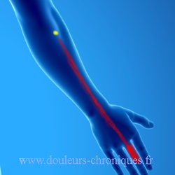 Syndrome myofascial des muscles extenseurs des doigts