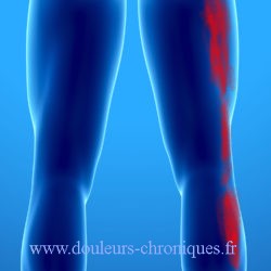 Chronic pain due to myofascial syndrome of the gluteus minimus muscle