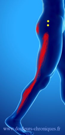 Chronic pain due to myofascial syndrome of the gluteus minimus muscle