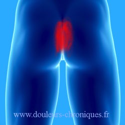 douleur chronique par syndrome myofascial du releveur de l'anus