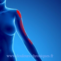Chronic pain due to myofascial syndrome of the supraspinatus muscle