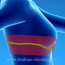 Cicatricial neuropathic pain of operated breast cancer