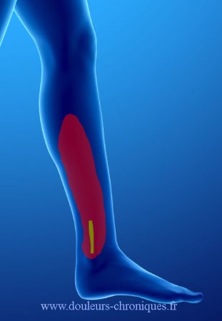 Neuropathic pain after ankle surgery