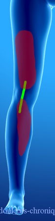 Chirurgie du genou (prothèse, arthroscopie, etc...). Topographie possible des douleurs neuropathiques en fonction des voies d'abord