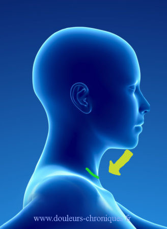 Movimiento de la cabeza en la neuropatía cicatricial lateral cervical anterior.